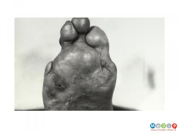 Scanned image showing a deformed foot.
