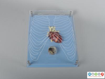 Front view of a model of a pacemaker showing the heart, device and ribs.
